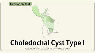 Choledochal Cyst Type I [upl. by Laws996]