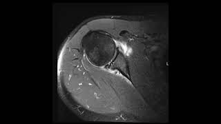 Reverse HillSachs defect and posterior labral tear with negative glenoid version [upl. by Rori]