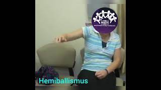 HEMIBALLISMUS [upl. by Kesia626]