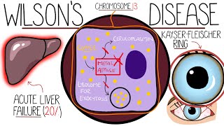 Understanding Wilsons Disease Hepatolenticular Degeneration [upl. by Volding]