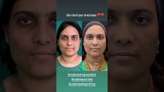 UNDEREYE HOLLOWNESSdranirbanghoshskincarebotoxcosmeticsurgery [upl. by Kral]