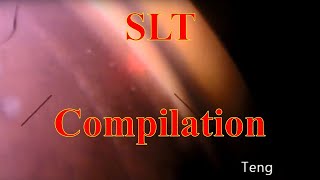 Selective Laser Trabeculoplasty SLT Compilation Chris Teng MD [upl. by Kcid]