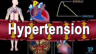 What hypertensionCausessymptomstreatment and preventionhypertension cure viral [upl. by Norvin]