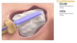 Negative pressure wound therapy from smith and nephew [upl. by Oz]