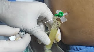 Remove abdominal fluid ascites  Paracentesis  Ascitic fluid aspiration [upl. by Rafaelita350]