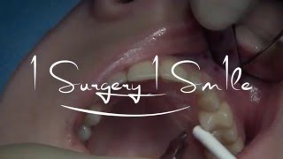 Impacted canine extraction and immediate placement 1 Surgery 1 Sm1le By Dr Bechara [upl. by Vijnas589]