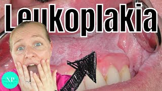 Leukoplakia  Causes Diagnosis amp Treatment WHAT CAUSES LEUKOPLAKIA [upl. by Ungley168]