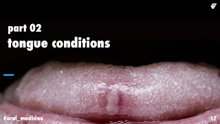 tongue conditions 2  oral medicine  عزت شومان [upl. by Frierson]