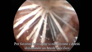 Otoscopia per Otite Purulenta Monolaterale Cane [upl. by Grew]