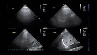 Normotensive Cardiogenic Shock [upl. by Lach]