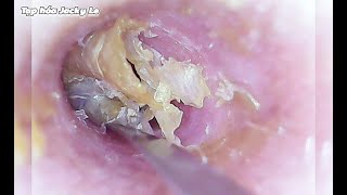 Ear Wax Removal 105 Wet And Sticky Earwax Causes Itching  Ear Cleaning ASMR Relaxing Video [upl. by Orsa148]