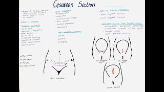 Cesarean Section  Types Indications Incisions etc [upl. by Aiza]