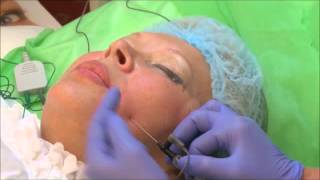 INNOplus RF subcision treatment [upl. by Amberly40]