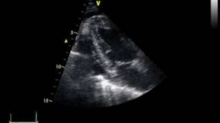 CHRONIC PERICARDITIS with thickening of the pericardium [upl. by Zrike360]