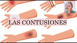 ¿QUÉ SON LAS CONTUSIONES HEMATOMA O quotMORATÓNquot FISIOPATOLOGÍA TIPOS DE CONTUSIONES [upl. by Aunson]