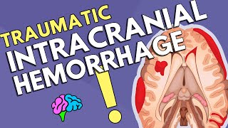 Intracranial Hemorrhage [upl. by Hayley389]