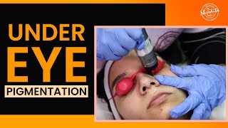 HOW TO GET RID OF UNDER EYE DARK CIRCLES [upl. by Rudy]