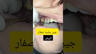 ازالة جير الاسنان dentist stitch اكسبلور stitchlover satisfying [upl. by Nirek]