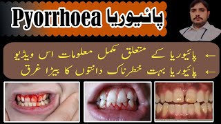 what is PYORRHEA پائیوریا treatment of pyorrhea symptoms information dentalissues treatment [upl. by Elurd288]