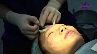 Glabella wrinkle treatment with stellar1Mono SC thread 30G 25mm by Dr Son [upl. by Nirehtac]