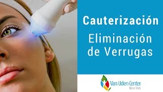 Cauterización  Eliminación de Verrugas  Dr Alfonso Van Uden [upl. by Siramed]