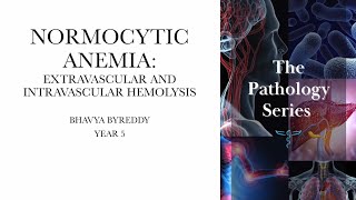 Normocytic anemia  With predominant intravascular and extravascular hemolysis [upl. by Lee]