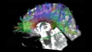 DTI Tractography of Corpus Callosum [upl. by Ormiston801]