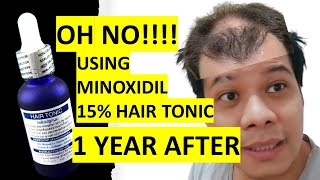 MINOXIDIL 15 Hair Tonic Results after 1 year  2021 Surprising OUTCOME [upl. by Vudimir]