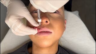 Expert Lip Filler Tutorial Safe Injection Techniques for Perfect Results [upl. by Marybelle]