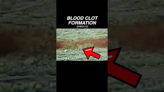 What is a BLOOD CLOT Doctor Explains medical education science [upl. by Arobed97]