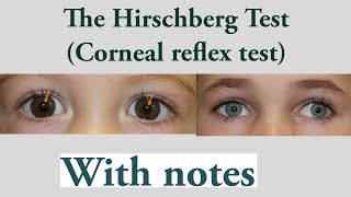 Hirschberg test Hirschberg corneal reflex testSquint lecture 10 [upl. by Ailis]