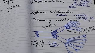 Embolism  Thromboembolism  pulmonary embolism  general pathology  Robbins pathology [upl. by Aurita]