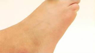 How To Cure Hallux Rigidus [upl. by Duax]