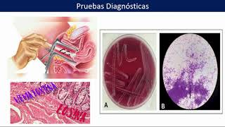 Actinomicosis Según la GPC Mexicana [upl. by Esenej342]