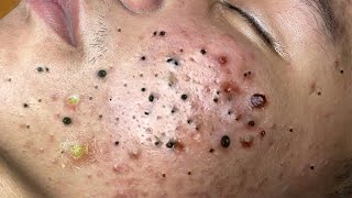 Big Cystic Acne Blackheads Extraction Blackheads amp Milia Whiteheads Removal Pimple Popping  6821 [upl. by Adiene]