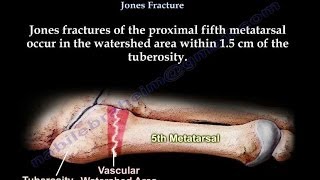 Jones Fractureproximal fifth metatarsal  Everything You Need To Know  Dr Nabil Ebraheim [upl. by Seigel194]