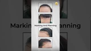 HAIR TRANSPLANT MALAYSIA  Hairline Transplant Witness the Transformation [upl. by Citarella392]