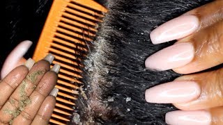 Scalp scratching and picking  Satisfying Dandruff Removal ASMR  Psoriasis [upl. by Amolap524]