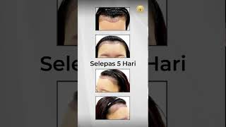 HAIR TRANSPLANT MALAYSIA  Hairline Transplant Day 5 PostSMART™ FUE Lowering Hairline [upl. by Iad]