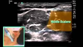 How To UltrasoundGuided Interscalene Block Scanning Technique Video [upl. by Burdelle]