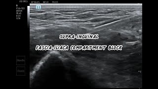 Supra Inguinal FasciaIliaca Block SIFI Block [upl. by Petrick]