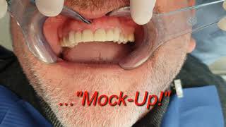 Tutorial dentista Il Mock Up Diretto Come migliorare il proprio Sorriso [upl. by Andee]