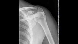 2 View Standard Shoulder Radiographic Tutorial [upl. by Follmer534]