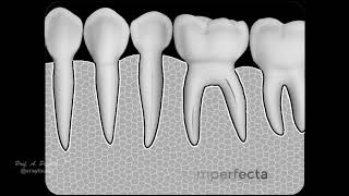 Dentinogenesis imperfecta [upl. by Chaffee]