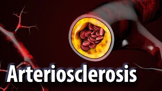 arteriosclerosis vs atherosclerosis causes symptoms and preventions [upl. by Freeborn]