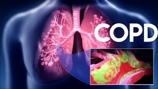 Chronic Obstructive Pulmonary Disease COPDUnit5Pulmonary NursingAHNII Bsn 4rth [upl. by Ener143]