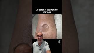 Pourquoi a t on les jambes gonflées [upl. by Gnidleif]