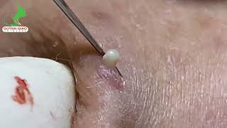 Satisfying SkinCare Blackheads Acne Extraction Video With Dr Thuy QGSPA Date Nov142024 [upl. by Ocirne]