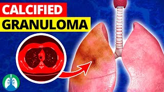 What is a Calcified Granuloma in the Lungs [upl. by Niroc914]