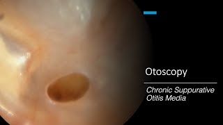 Chronic Suppurative Otitis Media Otoscopy [upl. by Quintie]